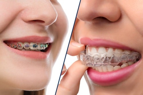 Braces versus Invisalign