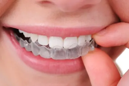 Tucson Invisalign and Clear Braces