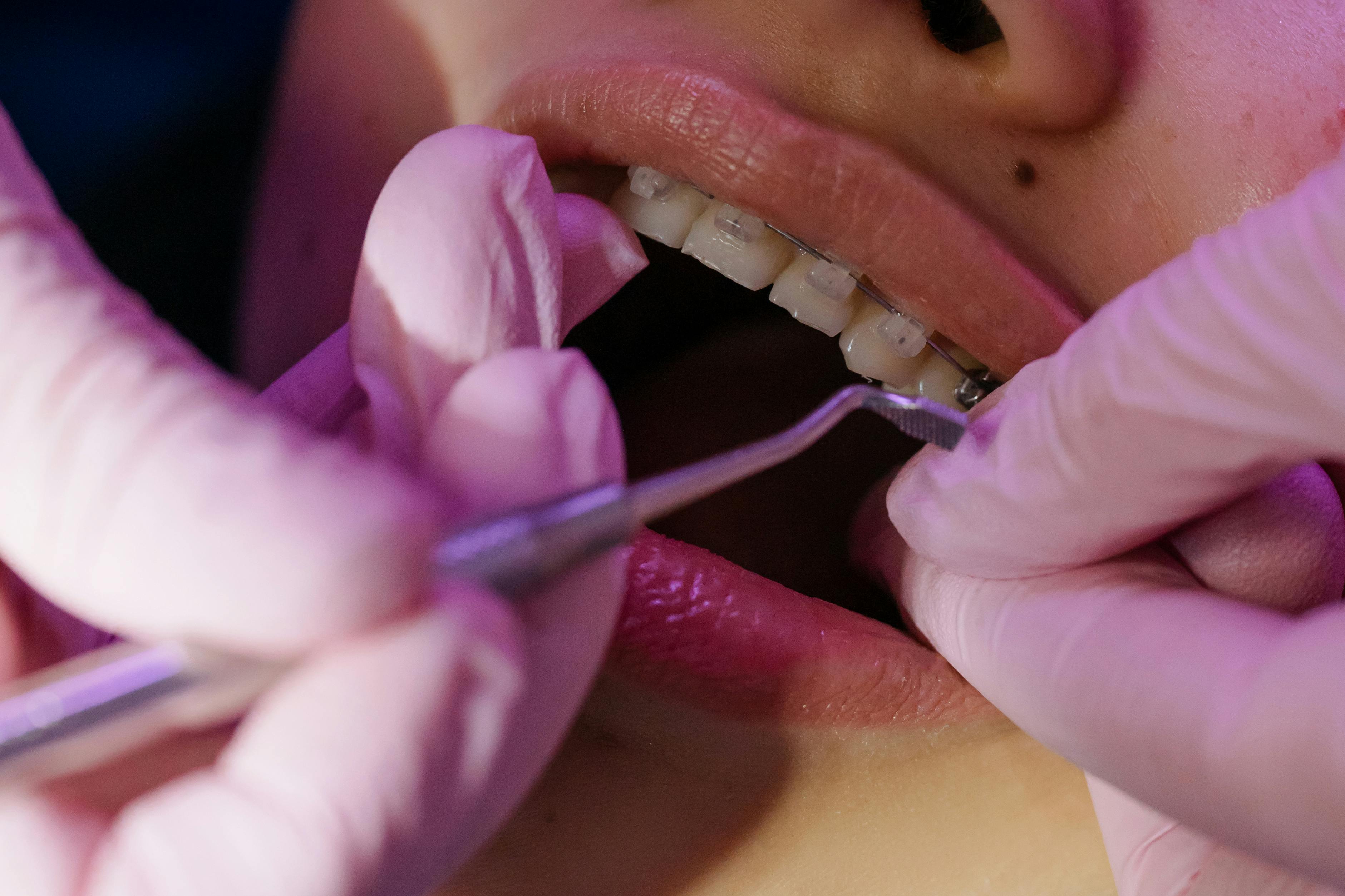 Braces Stock1 (1)